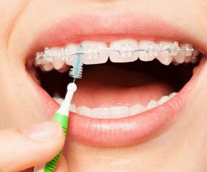 cepillarse los dientes con brackets